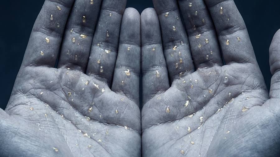 Hyperhidrosis ETS surgery