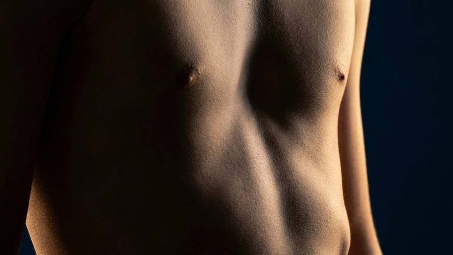 Pectus excavatum Nuss procedure